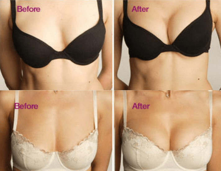 Instant Magnetic Therapy Breast Lift Bra Inserts